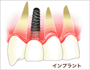 インプラントとは