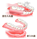 入れ歯とは？